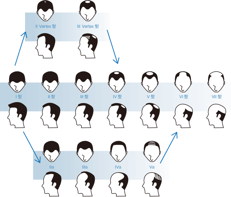 「M型の薄毛　Ⅱ Vertex型,Ⅲ Vertex型」「O型の薄毛　Ⅰ型,Ⅱ型,Ⅲ型,Ⅳ型,Ⅴ型,Ⅵ型,Ⅶ型」「全体的に後退　Ⅱa,Ⅲa,Ⅳa,Ⅴa」