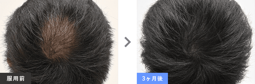 3ヶ月実感コース 症例写真 before after