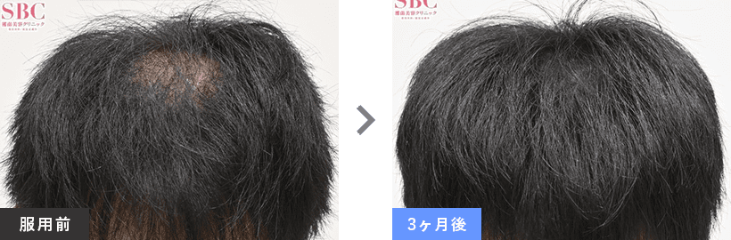 症例写真01 before after