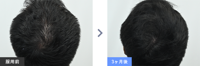 症例写真02 before after