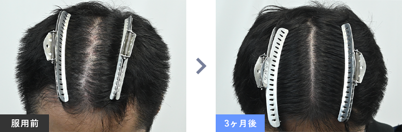 症例写真03 before after