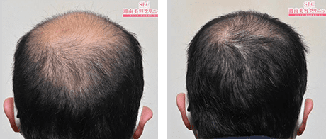 症例写真 30代 case03 before after