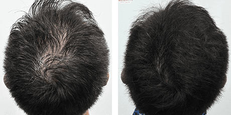 症例写真 40代 case04 before after