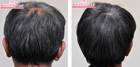 症例写真 50代 case03 before after